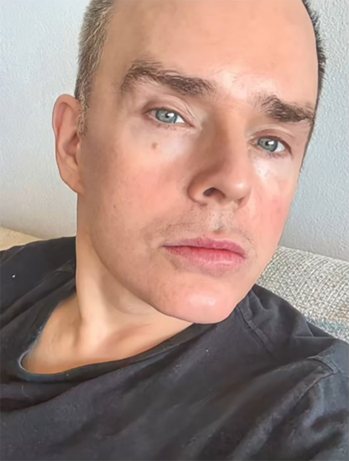 This Man Went To Mexico For A Facelift And Almost Broke The Internet With His Big Reveal