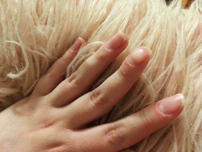&#8220;My Extra Finger&#8221;: 85 Fascinating And Wild Things That Can Happen To The Human Body (New Pics)