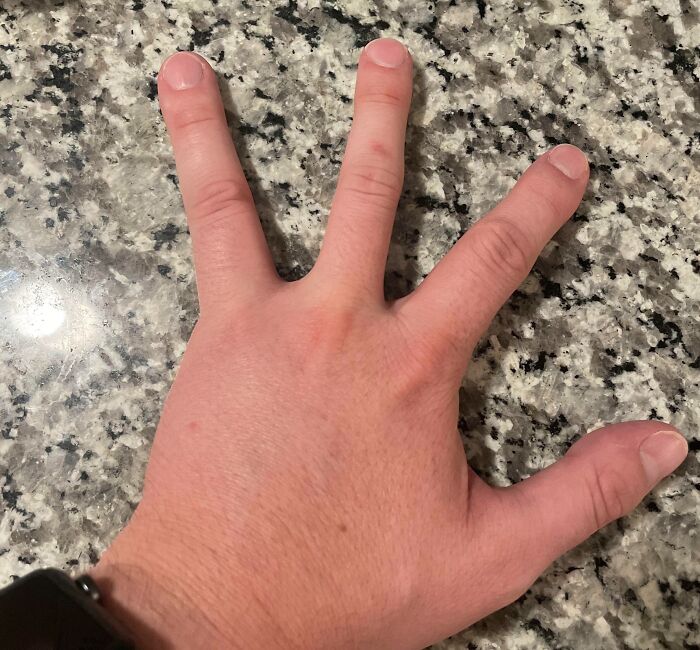 &#8220;My Extra Finger&#8221;: 85 Fascinating And Wild Things That Can Happen To The Human Body (New Pics)
