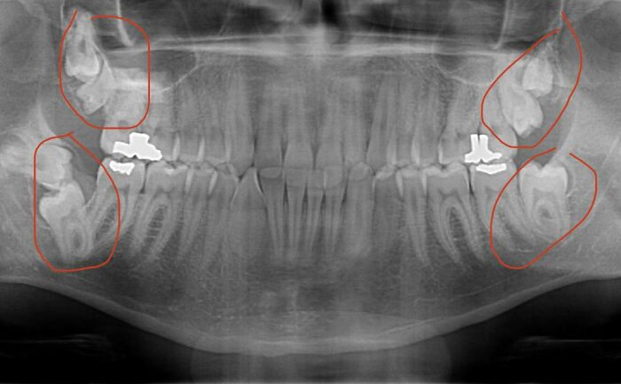 &#8220;My Extra Finger&#8221;: 85 Fascinating And Wild Things That Can Happen To The Human Body (New Pics)