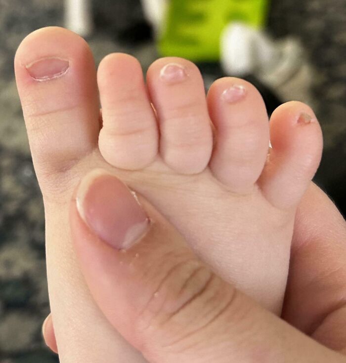 &#8220;My Extra Finger&#8221;: 85 Fascinating And Wild Things That Can Happen To The Human Body (New Pics)