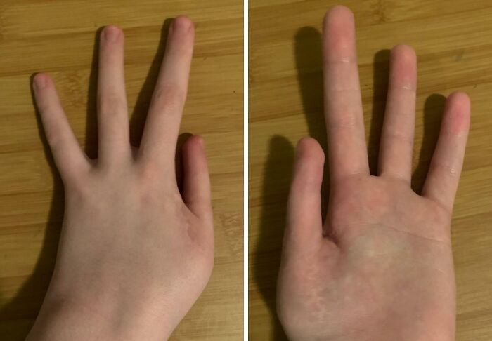 &#8220;My Extra Finger&#8221;: 85 Fascinating And Wild Things That Can Happen To The Human Body (New Pics)