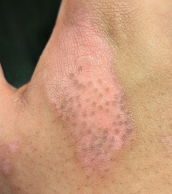 &#8220;My Extra Finger&#8221;: 85 Fascinating And Wild Things That Can Happen To The Human Body (New Pics)