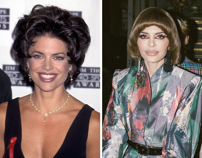 20 Before-And-After Pictures Of Celebs Who Went Too Far With Plastic Surgery