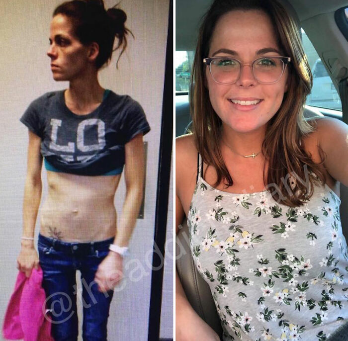 50 Before-And-After Pics And Inspiring Stories About Life-Changing Recoveries