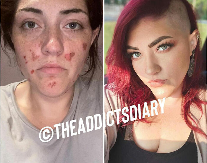 50 Before-And-After Pics And Inspiring Stories About Life-Changing Recoveries