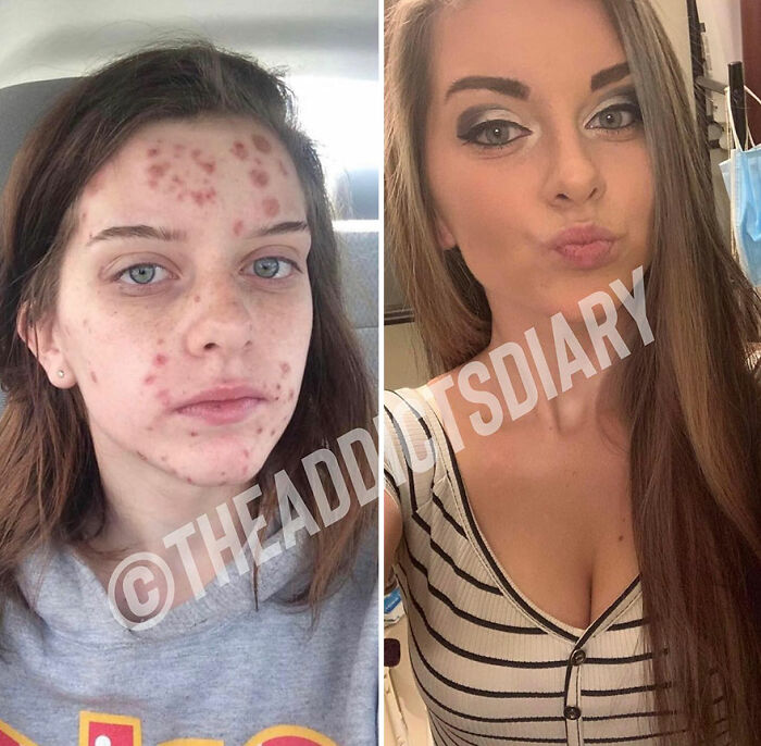 50 Before-And-After Pics And Inspiring Stories About Life-Changing Recoveries