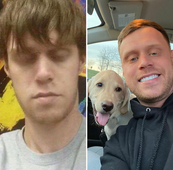 50 Before-And-After Pics And Inspiring Stories About Life-Changing Recoveries