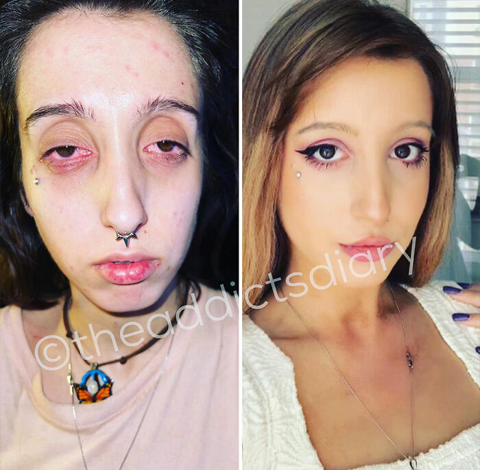 50 Before-And-After Pics And Inspiring Stories About Life-Changing Recoveries