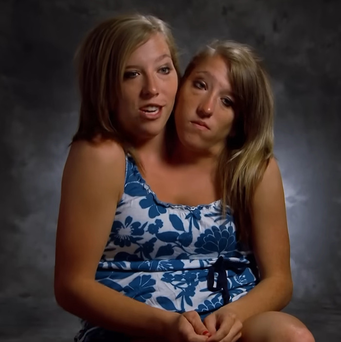&#8220;They Look Like They Need Sleep&#8221;: Abby &#038; Brittany Hensel’s Baby Sets Off Heated Discussion