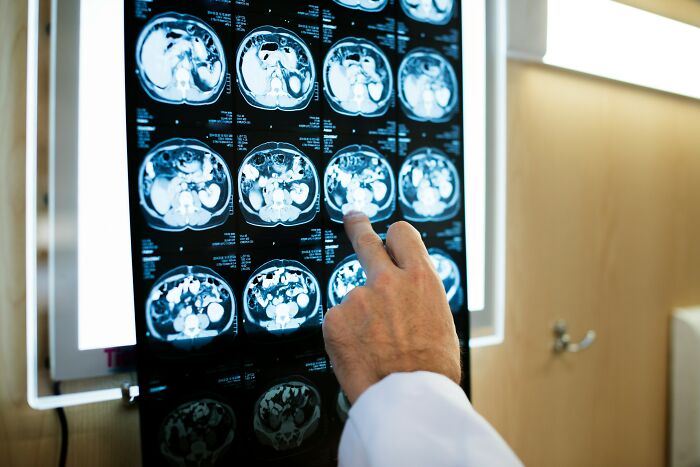 Man Develops ‘Pork Worms’ In His Brain After Common Bacon Habit