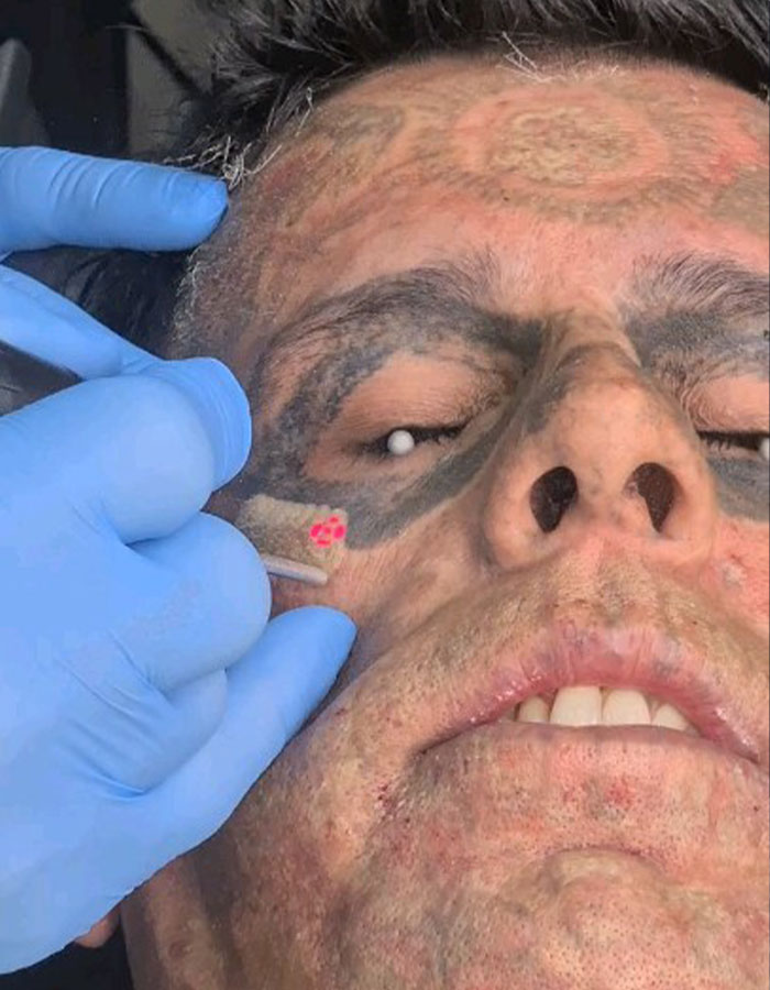 &#8220;Looked Better With Them&#8221;: 95% Tattooed Man Reveals Shocking Look After Laser Removal