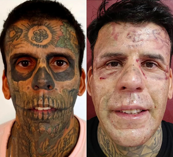 &#8220;Looked Better With Them&#8221;: 95% Tattooed Man Reveals Shocking Look After Laser Removal