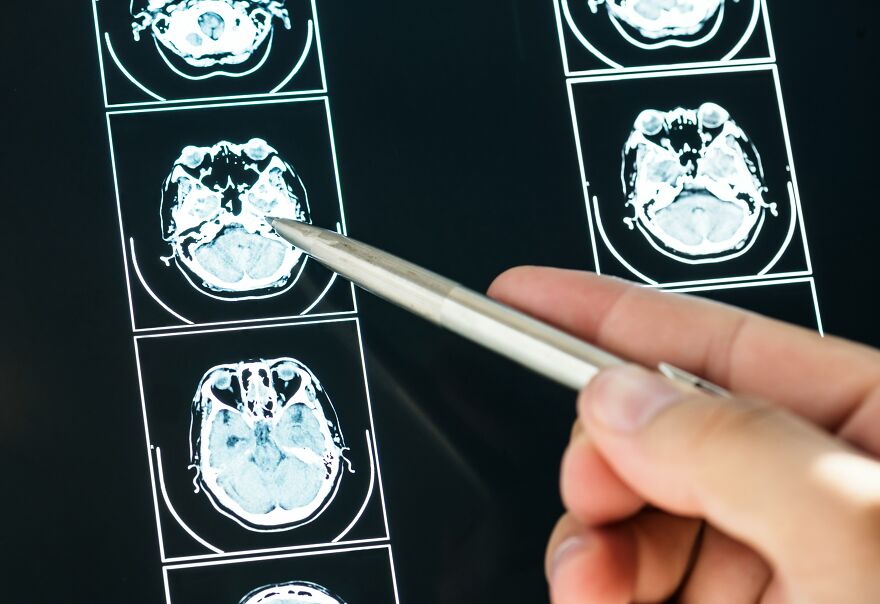 Neurologist Warns Against Popular Post-Exercise Habit That Could Trigger Strokes And Dementia