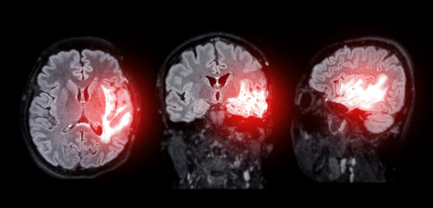 Neurologist Warns Against Popular Post-Exercise Habit That Could Trigger Strokes And Dementia