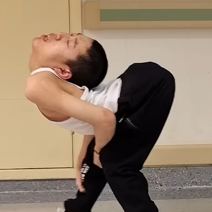 &#8216;Folded Boy&#8217; Who Was Bent At 180 Degrees For Most Of His Life Stuns With &#8216;Magical&#8217; Transformation