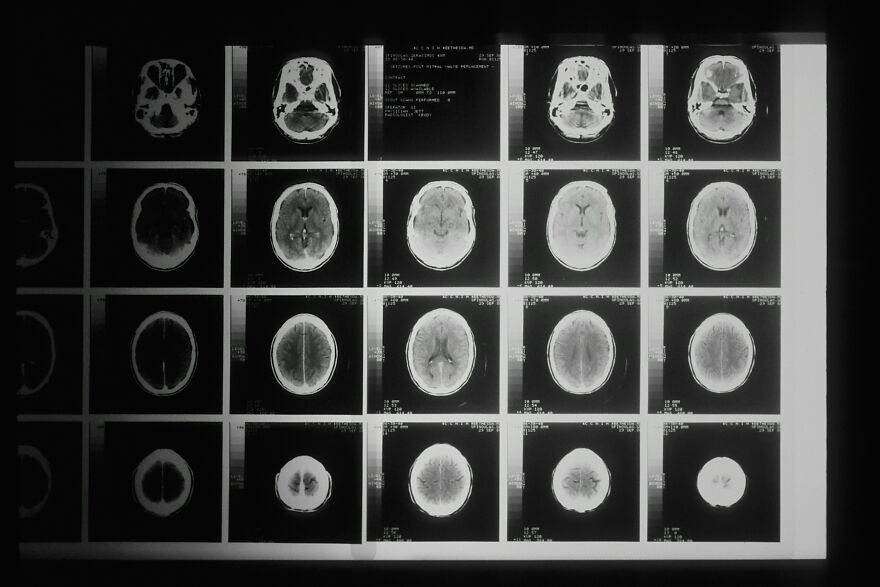 &#8220;I&#8217;m Glad I&#8217;m Poor&#8221;: Scientists Link Wealthy-Favored Superfood To ALS, Or Lou Gehrig’s Disease