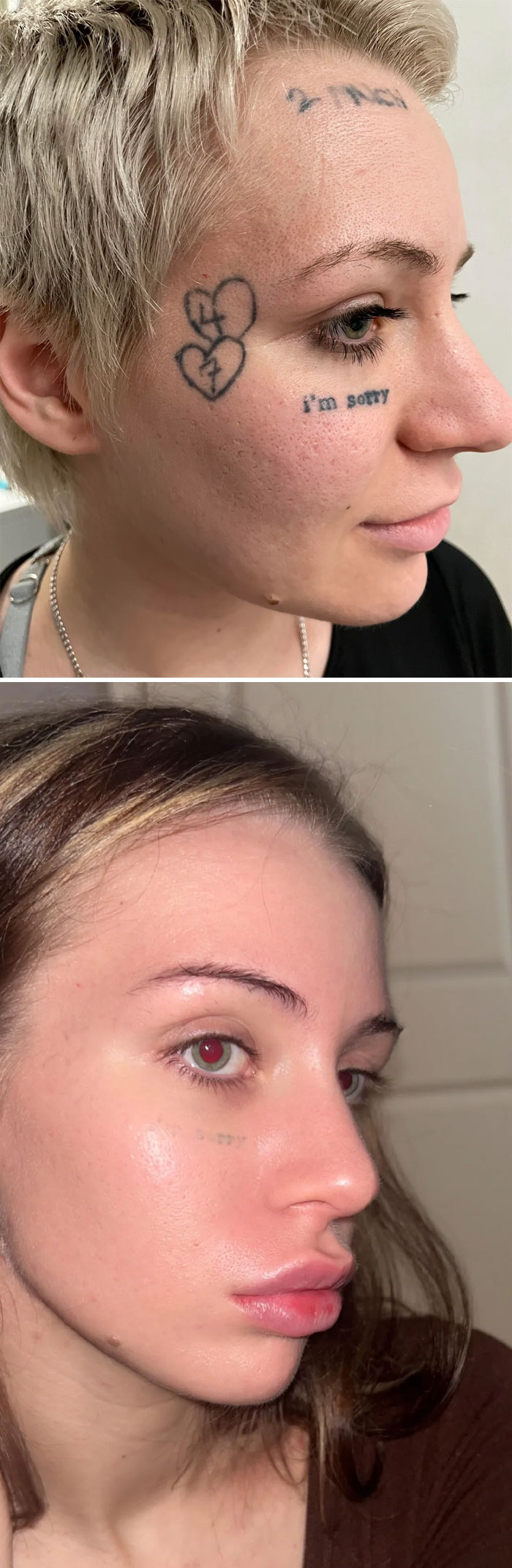 “Changed My Life!” 80 Photos Before And After Tattoo Removal