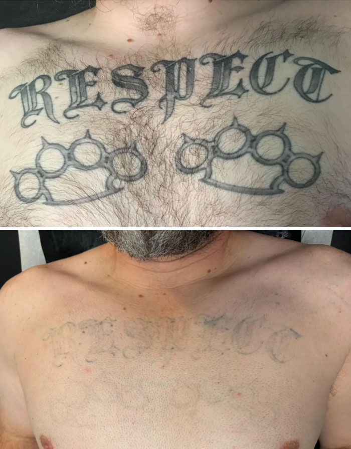 “Changed My Life!” 80 Photos Before And After Tattoo Removal