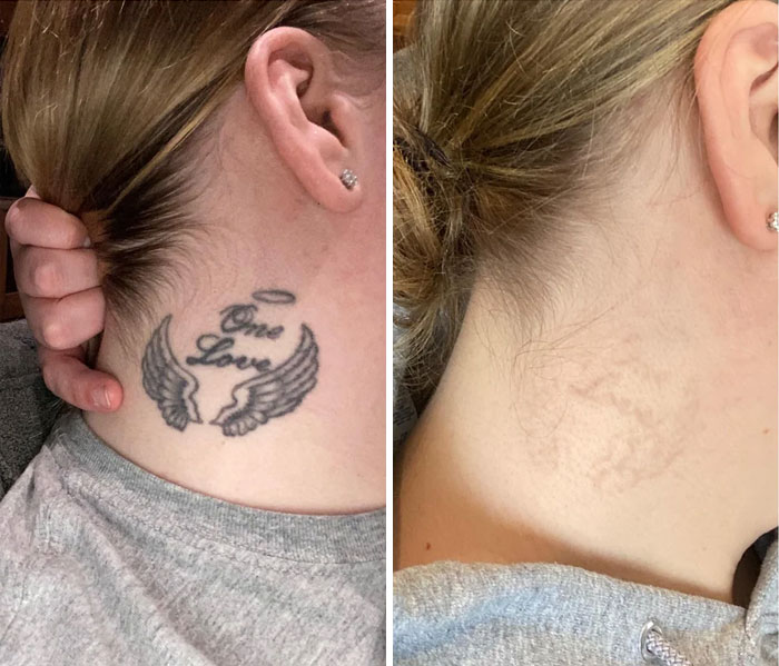 “Changed My Life!” 80 Photos Before And After Tattoo Removal