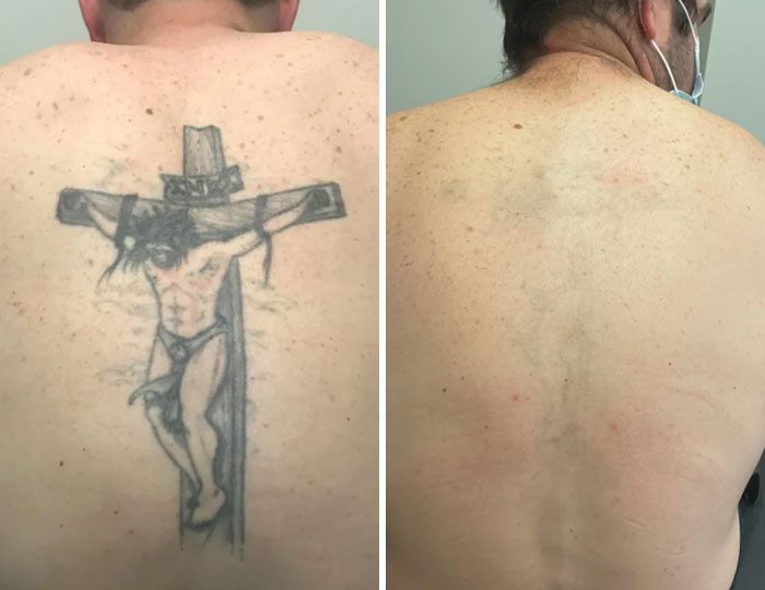 “Changed My Life!” 80 Photos Before And After Tattoo Removal