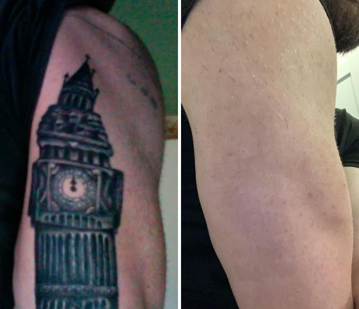 “Changed My Life!” 80 Photos Before And After Tattoo Removal