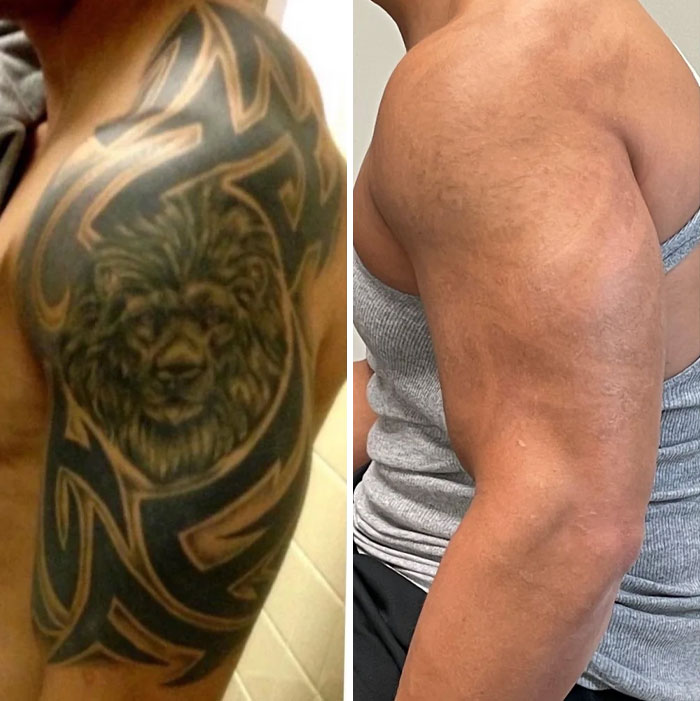 “Changed My Life!” 80 Photos Before And After Tattoo Removal