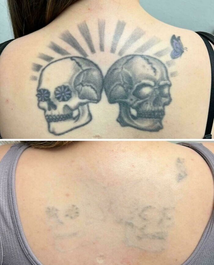 “Changed My Life!” 80 Photos Before And After Tattoo Removal