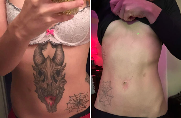 “Changed My Life!” 80 Photos Before And After Tattoo Removal
