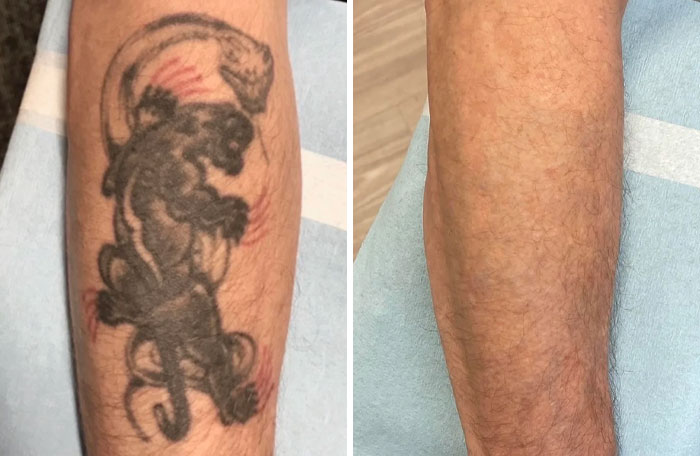 “Changed My Life!” 80 Photos Before And After Tattoo Removal