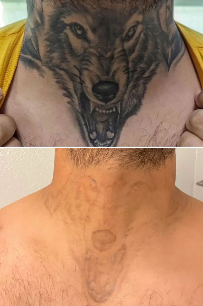 “Changed My Life!” 80 Photos Before And After Tattoo Removal