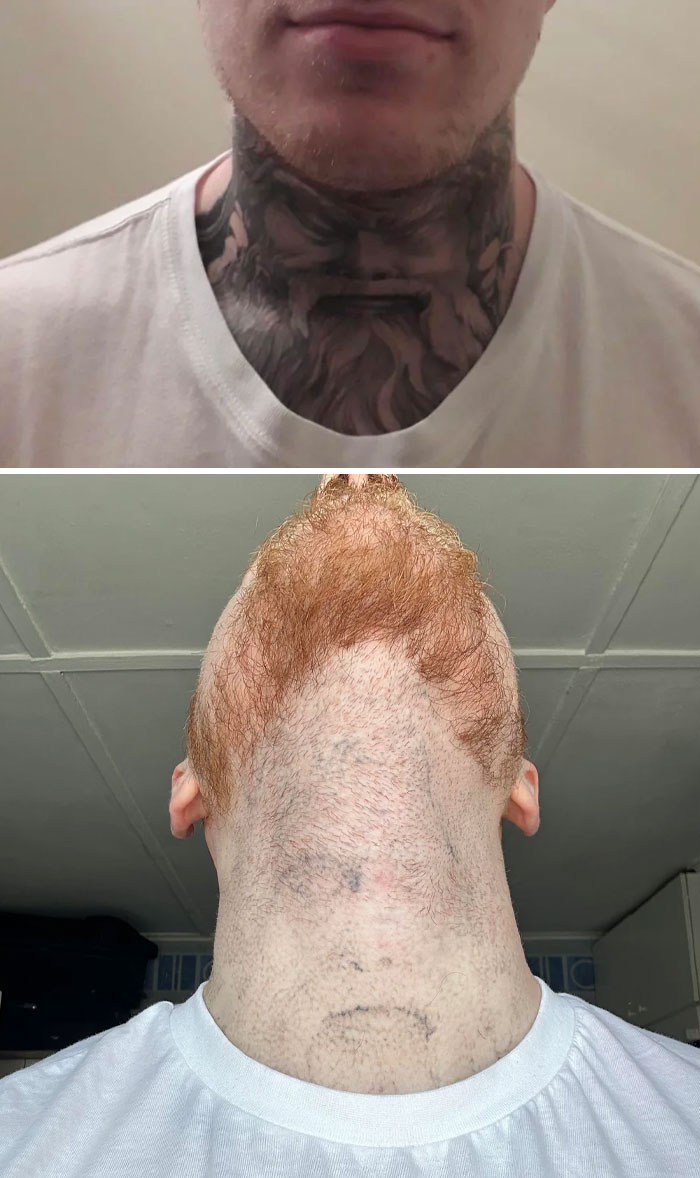 “Changed My Life!” 80 Photos Before And After Tattoo Removal