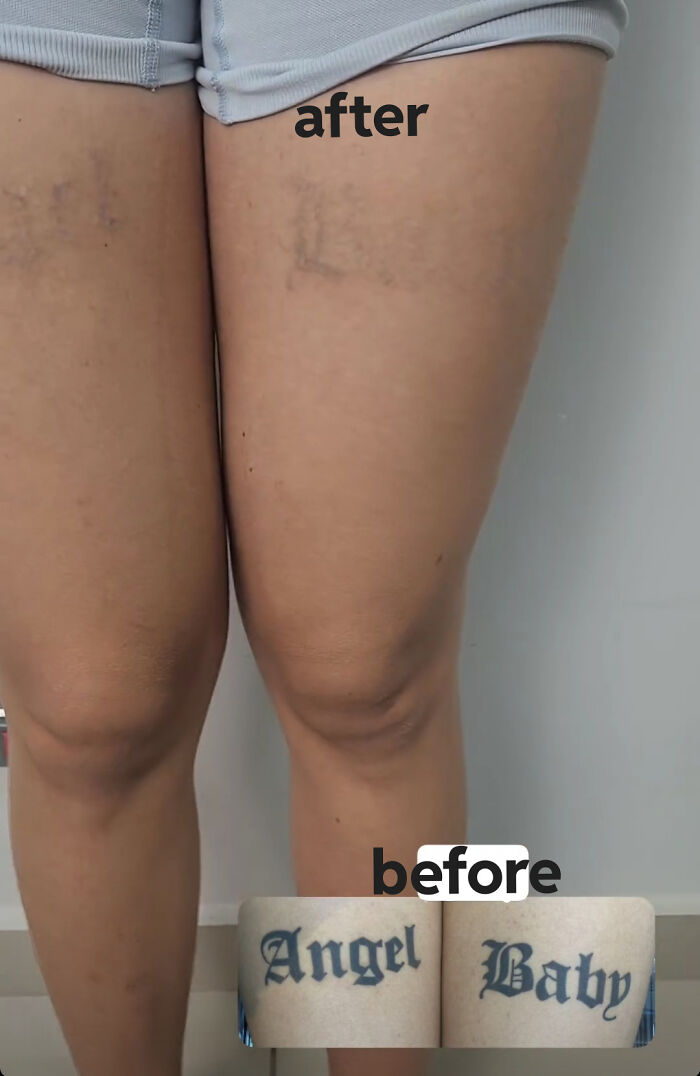 “Changed My Life!” 80 Photos Before And After Tattoo Removal