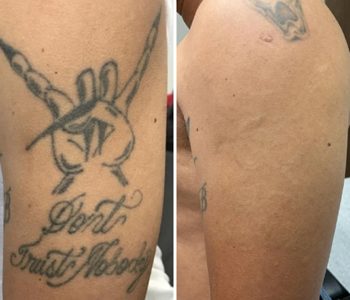 “Changed My Life!” 80 Photos Before And After Tattoo Removal