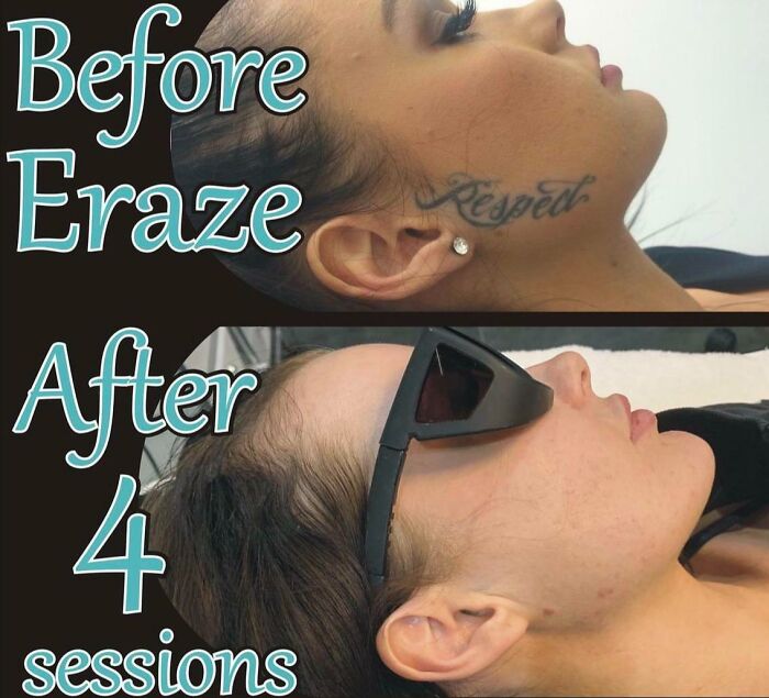 “Changed My Life!” 80 Photos Before And After Tattoo Removal