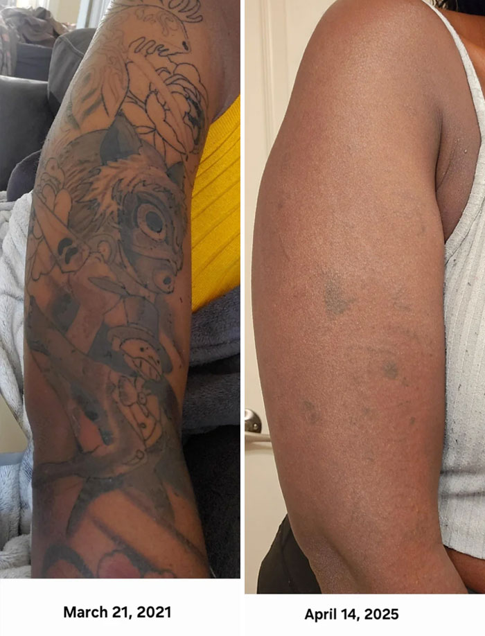 “Changed My Life!” 80 Photos Before And After Tattoo Removal