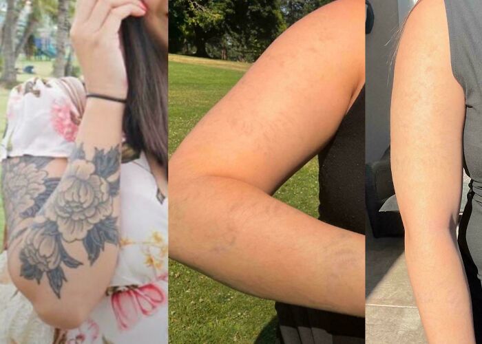 “Changed My Life!” 80 Photos Before And After Tattoo Removal