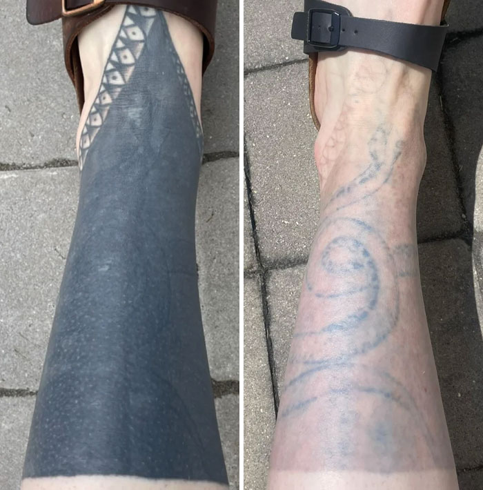 “Changed My Life!” 80 Photos Before And After Tattoo Removal