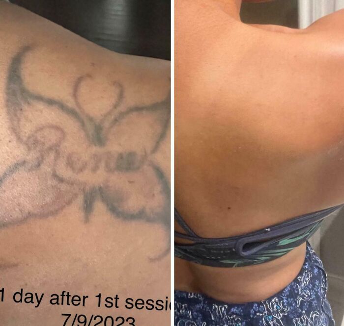 “Changed My Life!” 80 Photos Before And After Tattoo Removal