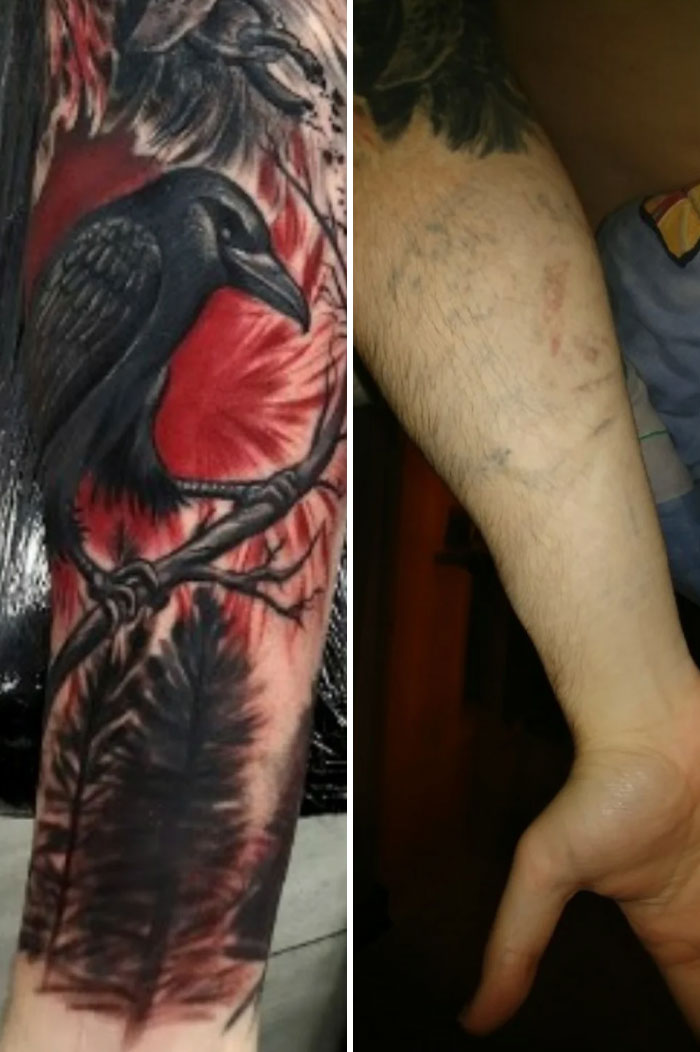 “Changed My Life!” 80 Photos Before And After Tattoo Removal