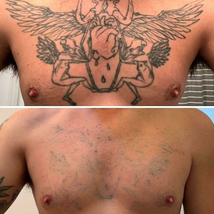 “Changed My Life!” 80 Photos Before And After Tattoo Removal