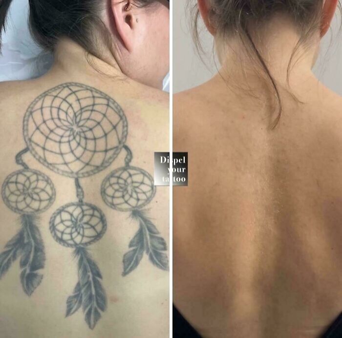“Changed My Life!” 80 Photos Before And After Tattoo Removal