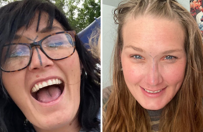 “Changed My Life!” 80 Photos Before And After Tattoo Removal