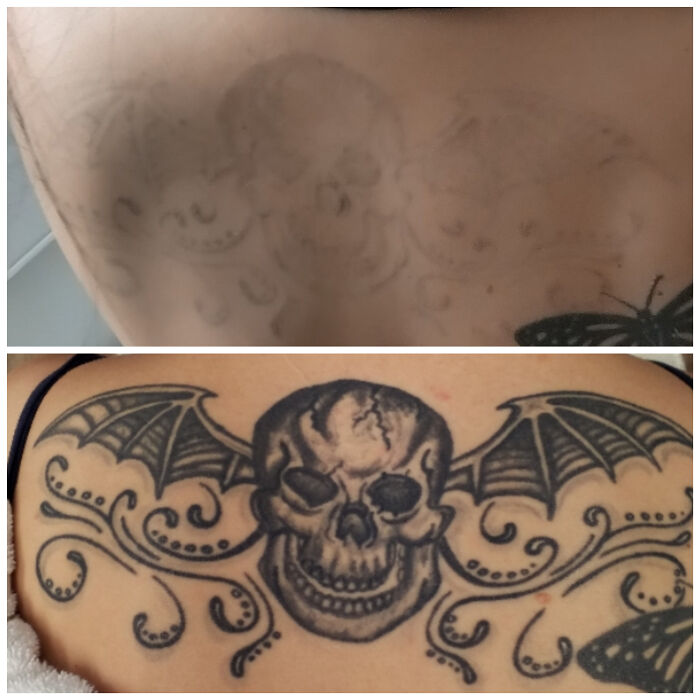 “Changed My Life!” 80 Photos Before And After Tattoo Removal