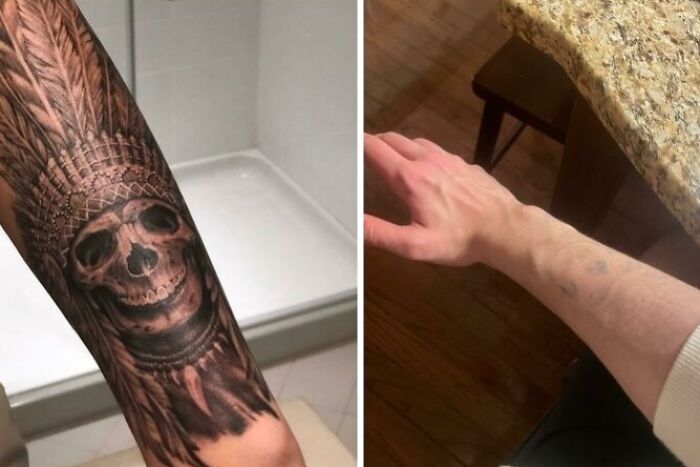 “Changed My Life!” 80 Photos Before And After Tattoo Removal