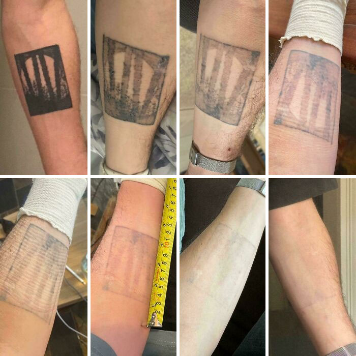 “Changed My Life!” 80 Photos Before And After Tattoo Removal
