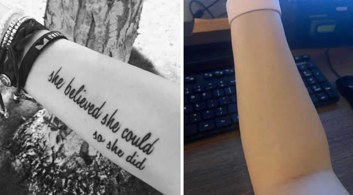 “Changed My Life!” 80 Photos Before And After Tattoo Removal