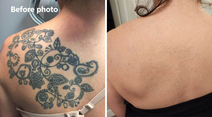 “Changed My Life!” 80 Photos Before And After Tattoo Removal