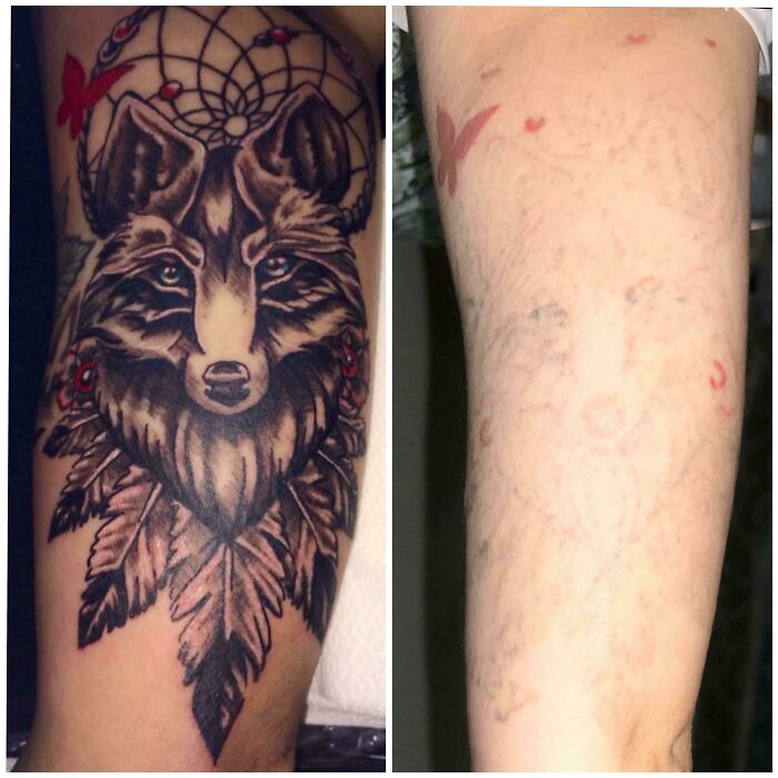 “Changed My Life!” 80 Photos Before And After Tattoo Removal