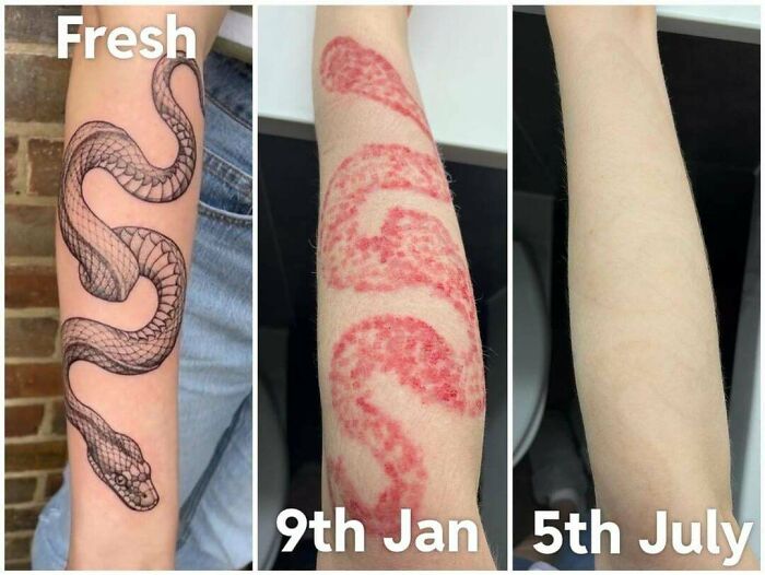 “Changed My Life!” 80 Photos Before And After Tattoo Removal